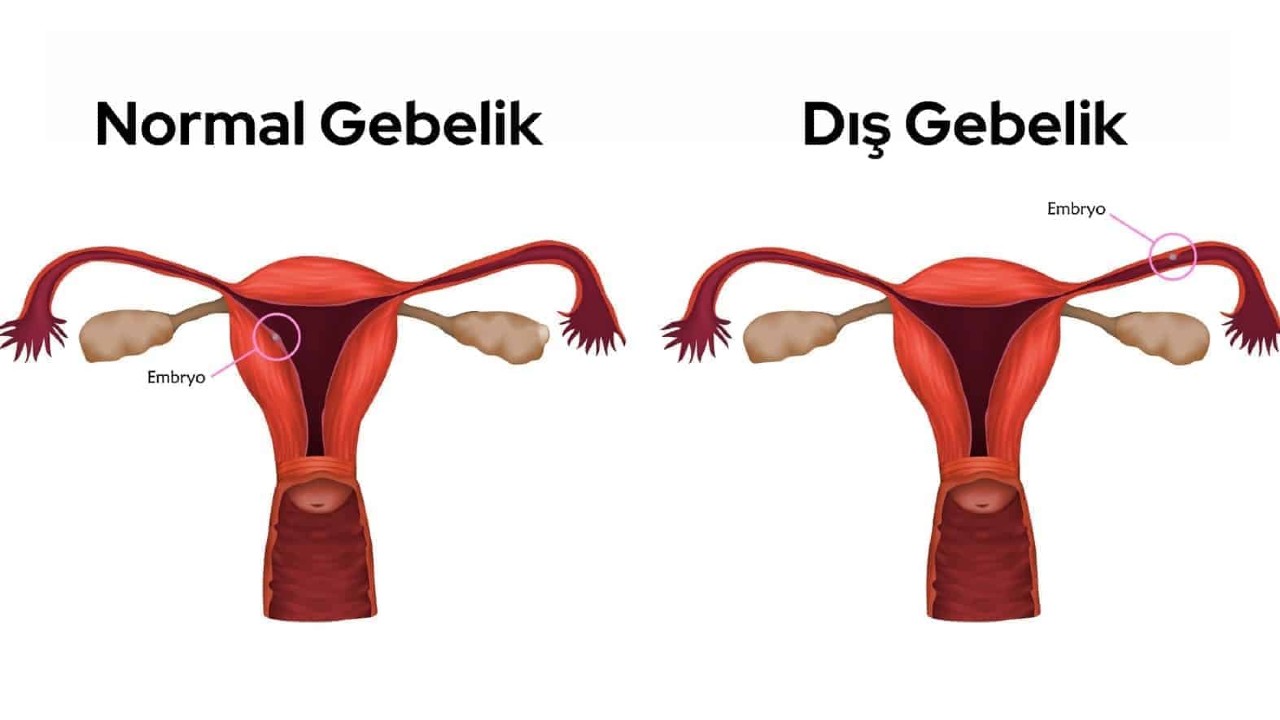 dış gebelik